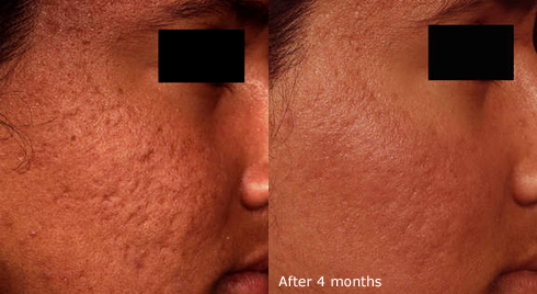 Acne treatment results