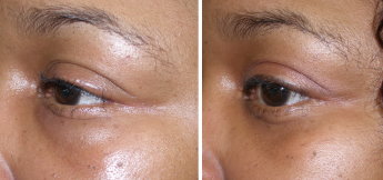Dissolve Excess Filler with Hyaluronidase