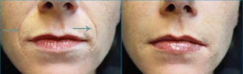 Dermal filler results