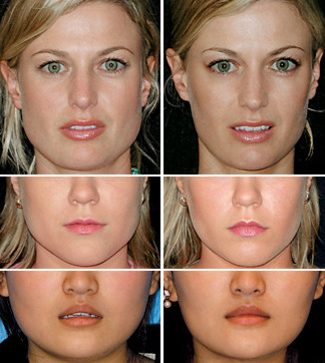Jaw Reduction Botox results