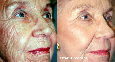 Laser skin tightening results