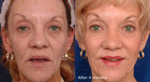 Laser skin tightening results