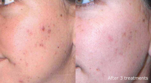 Facial Peel results