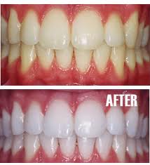 Teeth Whitening Results